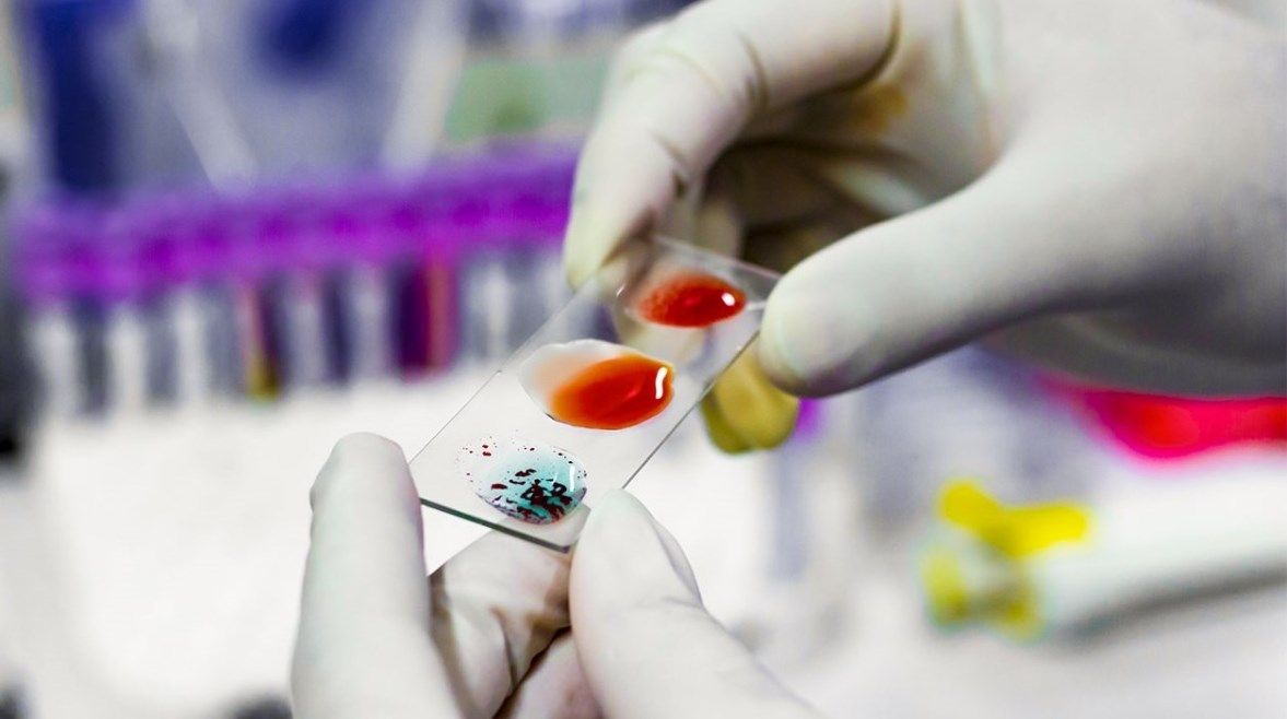 عاجل: تحملها امرأة واحدة.. اكتشاف فصيلة دم نادرة