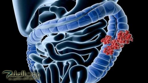 كنز ثمين لا يقدر بثمن في كل بيت.. عشبة بسيطة تنظف القولون من البراز المتحجر والفضلات في دقائق معدودة دون