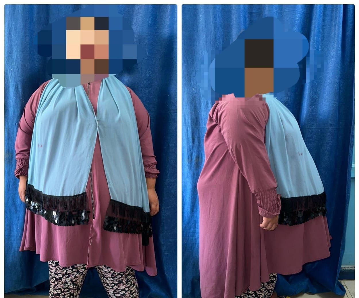 عاجل: عملية ناجحة لـ”صغيرة” تعاني من سمنة مفرطة بمستشفى جامعة أسيوط