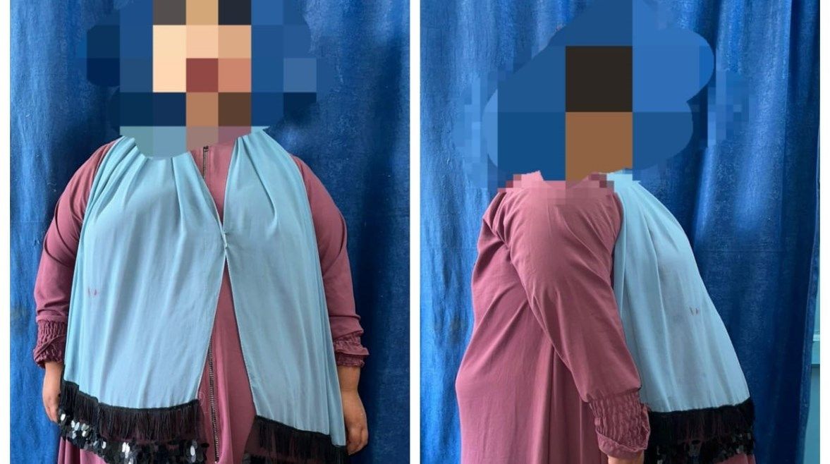 عاجل: عملية ناجحة لـ”صغيرة” تعاني من سمنة مفرطة بمستشفى جامعة أسيوط