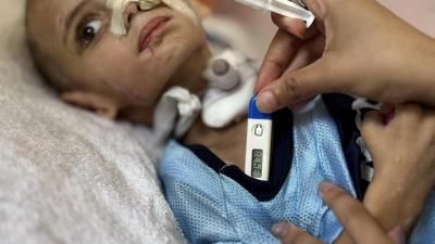 أخبار اليمن : سوء التغذية يقتل 66 طفلاً في غزة