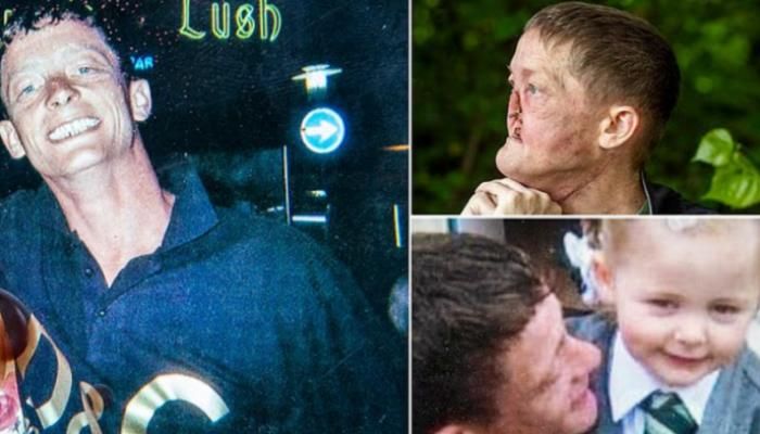 عاجل: كارثة بدأت باحتقان بسيط.. رجل يفقد أنفه بسبب سرطان خادع