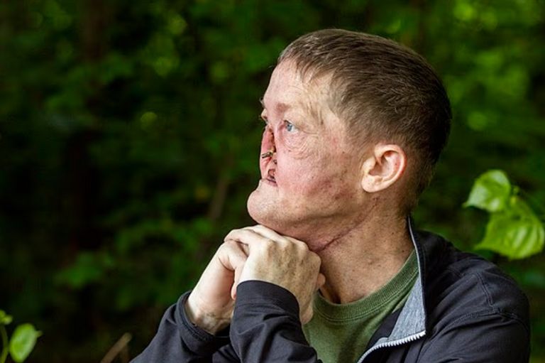 عاجل: كارثة بدأت باحتقان بسيط.. رجل يفقد أنفه بسبب سرطان خادع