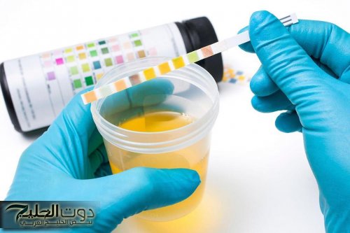 دراسة طبية.. تغير لون البول قد يشير إلى أمراض خفية يجب عدم تجاهلها