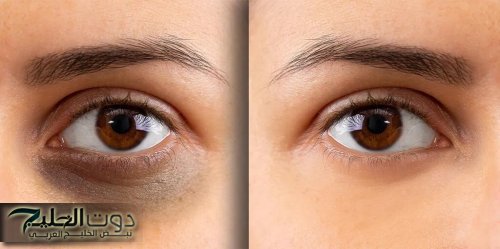 مكون سحرى لعلاج الهالات السوداء من مطبخك