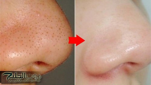 بشرتك هتنور في يومين..تخلصي من الرؤوس السودة في بيتك وبمكونات طبيعية!