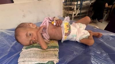 أخبار اليمن : 14 حالة وفاة جديدة بسبب المجاعة في غزة