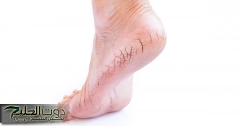 «متتقدرش بكنوز».. ملعقتان خل وفي يوم واحد هتتخلصي من تشققات الكعبيين وتصبغات القدمين