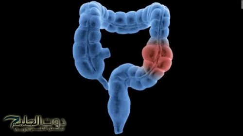 «قاهر البراز المتحجر».. عشبة جبارة موجودة في كل مطبخ تنظف القولون في 5 دقائق وتعتبر الحل الأمثل للتخلص