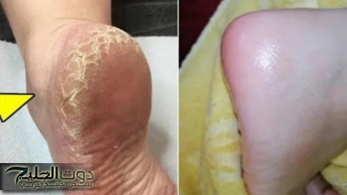«اسحريهم بجمال خطوتك».. طريقة جهنمية للقضاء على تشققات الكعبين وإزالة الجلد الميت في ثواني.. ما تروحيش