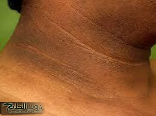 احذروا.. علامات تظهر فى الرقبة تدل على مرض خطير ليس له علاج| تعرف عيه قبل فوات الأوان