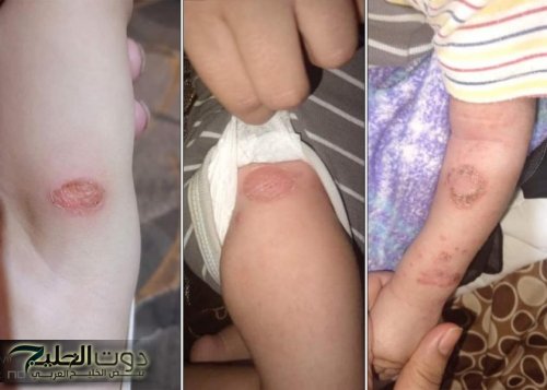 «رعب صحي جديد!».. انتشار فيروس جلدي غامض في معان يهدد الأطفال والكبار وسط تحذيرات عاجلة من الأطباء!
