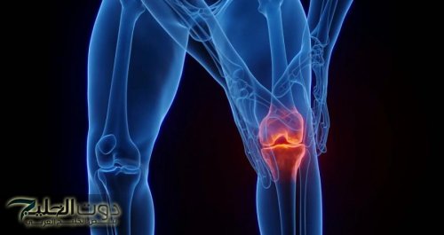 علاج جديد لهشاشة المفاصل يخفف ألم الركبة