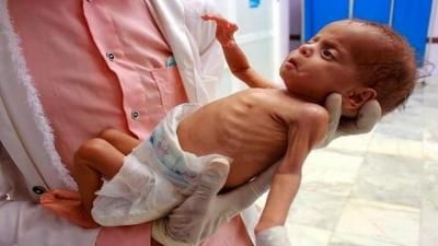 أخبار اليمن : ارتفاع عدد شهداء التجويع بغزة إلى 263