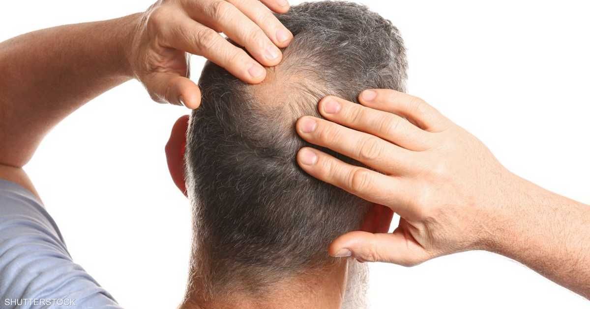 العالم اليوم - زيت بذور اليقطين.. حل طبيعي لتساقط الشعر ولكن ليس للجميع