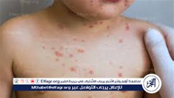 زيادة حالات الجدري المائي بين تلاميذ مدرسة ابتدائية.. اعرف الأعراض والعلاج وطرق الوقاية