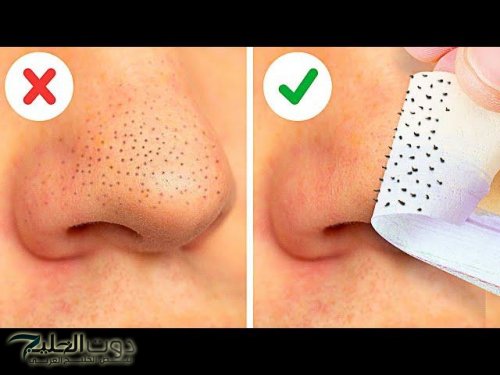 ودعي انسداد المسام.. كيفية التخلص من الرؤوس السوداء بطريقة آمنة وفعالة