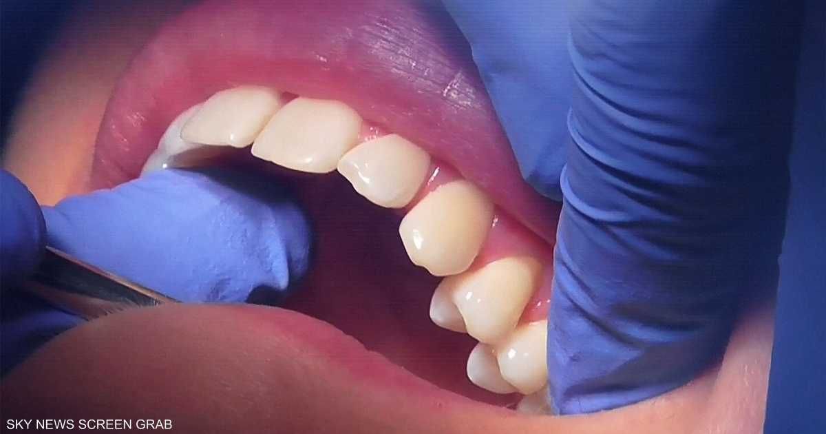 العالم اليوم - علماء يطورون هلاما لإصلاح الأسنان التالفة دون جراحة