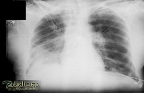 ما مدى خطورة الأشعة السينية على الصحة