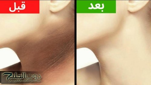 ودعي اسمرار الرقبة المحرج.. وصفات تفتيح الرقبة وعلاج التصبغات الناتجة عن الاحتكاك طبيعياً
