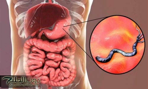 هل أنت مصاب بجرثومة المعدة دون أن تعلم؟!.. اكتشف الأعراض وطرق العلاج مبكراً قبل فوات الأوان