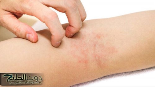 الحكة في الجسم .. الأسباب والعلاج