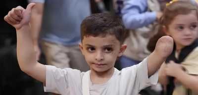 أخبار اليمن : 6 آلاف حالة بتر جراء حرب الإبادة في غزة