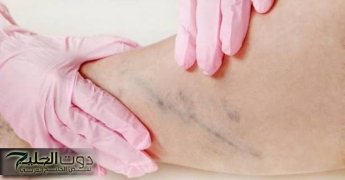 تحذير طبي: جلطة الساق ومخاطرها القاتلة