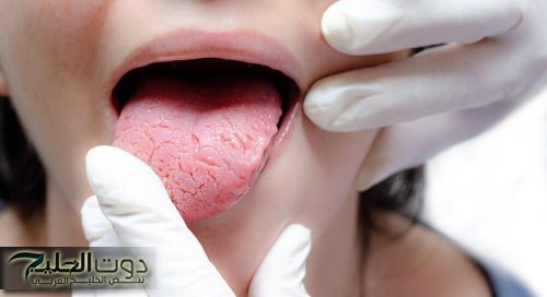 كيف تعرف مرضك من لسانك؟.. 8 ألوان تخبرك بحالتك الصحية
