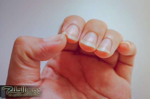 6 علامات في الأظافر تكشف عن أمراض خطيرة.. منها السرطان