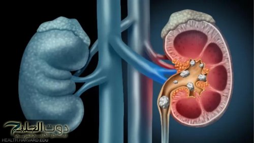أداة ذكاء اصطناعي جديدة من إستونيا تكشف سرطان الكلى
