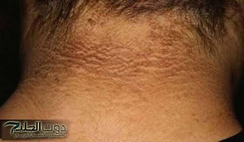 لا تتجاهلها أبدًا.. هذه العلامة قد تكون جرس إنذار لاضطراب خطير في الجسم