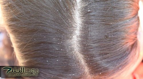 كابوس الشتاء.. 4 طرق طبيعية للتخلص من قشرة الرأس نهائيا