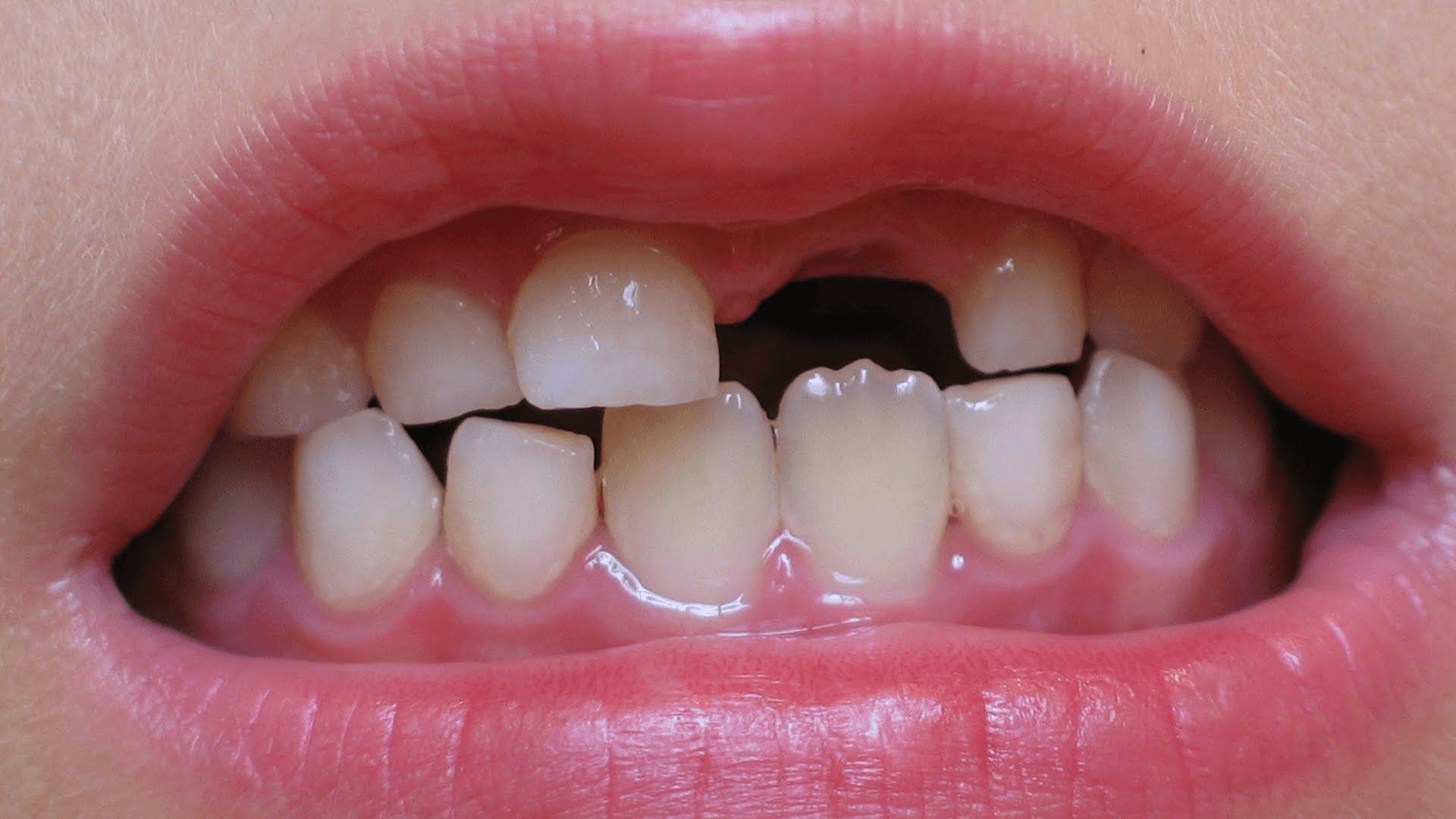 تفسير حلم سقوط سن واحد من الفك العلوي...