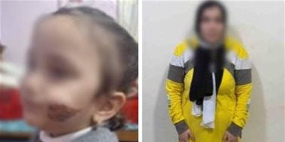 نقل حضانة الطفلة أسيل لجدتها من الأب بعد تعرضها للكوى بشوكة من والدتها