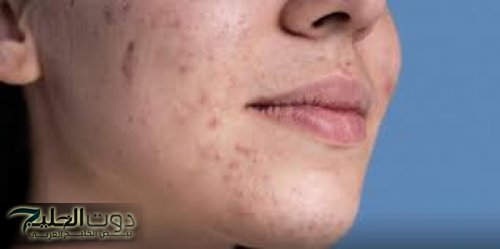 أخطاء شائعة للعناية في البشرة الدهنية