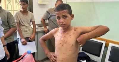 أخبار اليمن : الجرذان تفاقم الأمراض الجلدية في غزة