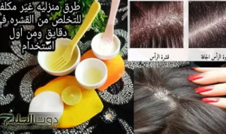 "انسى مشكلة قشرة الشعر والتساقط خالص".. طرق فعالة لعلاج قشرة الشعر وتساقطه بوصفات سهله وسريعة!!