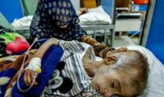 أخبار اليمن : وفاة 60 طفلاً نتيجة سوء التغذية في غزة