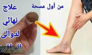 " النبتة المعجزة ” .. تعرف على العشبة العجيبة المتوفرة بكل بيت تقضي على الدوالي وتيبس المفاصل نهائيًا