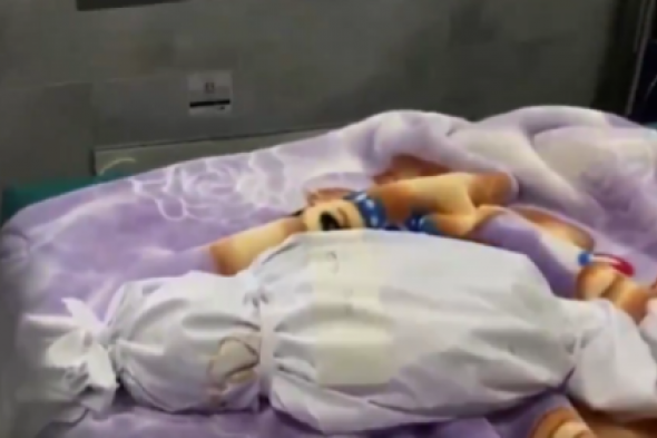 استشهاد طفلتين .. يرفع حصيلة ضحايا سوء التغذية في غزة