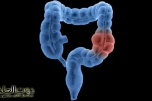 "لازم تعرفها دلوقتي قبل بكرة"..وداعًا للبراز المتحجر: جرب هذه العشبة الطبيعية لتنظيف القولون بسرعة!