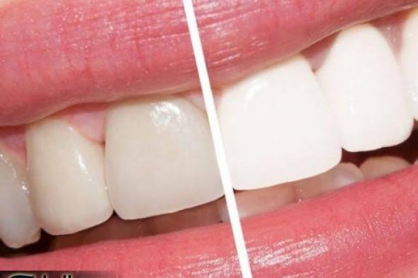 سنانك هتلمع زي الألماظ.... وصفات طبيعية مدهشة لـ تبييض الأسنان بمكونات منزلية اقتصادية..ضحكتك هتنور من تاني!!