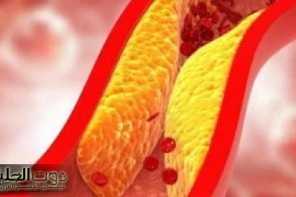 خلي بالك من صحتك!!... 4 علامات تدل على ارتفاع الكوليسترول في الدم... تعرف عليها بسرعة!!