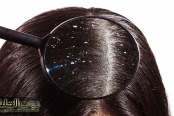 «جربيها وهتدعيلي ومن أول مره!»..وصفة جهنمية جبارة للتخلص من قشرة الشعر نهائياً خلال 30 دقيقة ودون الحاجة للكيماويات!!