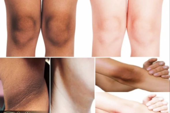 «هتنوري في الضلمة!!»..تفتيح المناطق الداكنة والسوداء سواد السنين والبشرة 5 درجات في يومين فقط بدون كريمات او عمليات!!