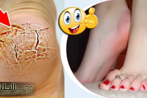 ” وصفة مغربية جبارة “.. طريـقة فعالة للتخلص نهـائيا من تشققات الكعبين وازالة الجلد الميت من اول استعمال!!.. جوزك هيـموت عليكى !!