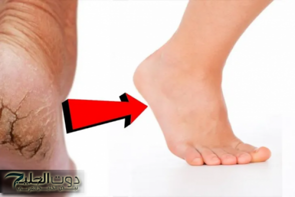 وصفات فعالة في التخلص من تشققات القدمين بوصفة منزلية سريعة ونتيجة مجربة ومضمونة100٪