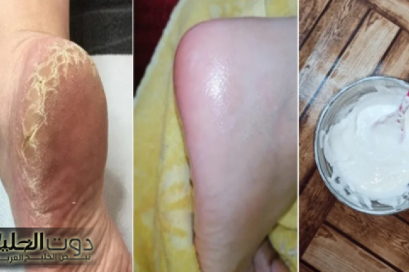 طريقة التخلص من تشققات القدمين وأفضل طريقة للتقشير والتخلص من الجلد الميت
