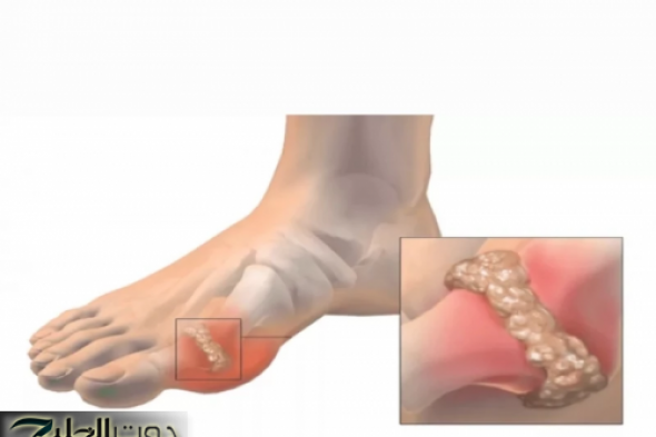 "عشبة سماوية".. تعالج النقرس والملاريا وآلام المفاصل وانسداد الأمعاء ولها فوائد لا تخطر على بال أحد!!